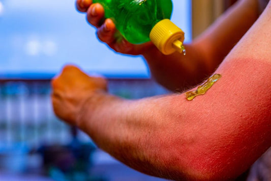 Sunburn Recovery: What to Do When Prevention Fails
