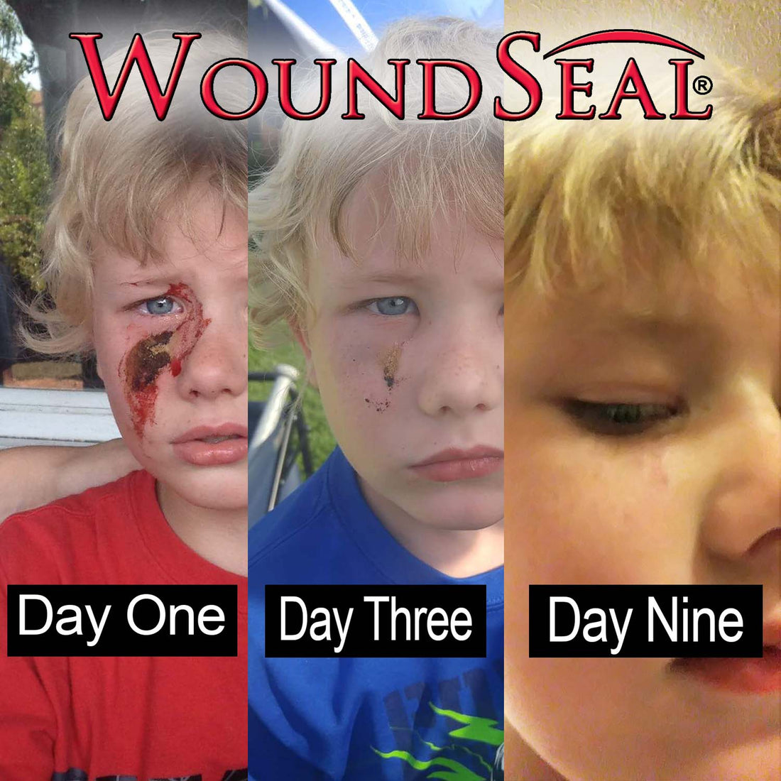 WoundSeal Stop Bleeding Instantly